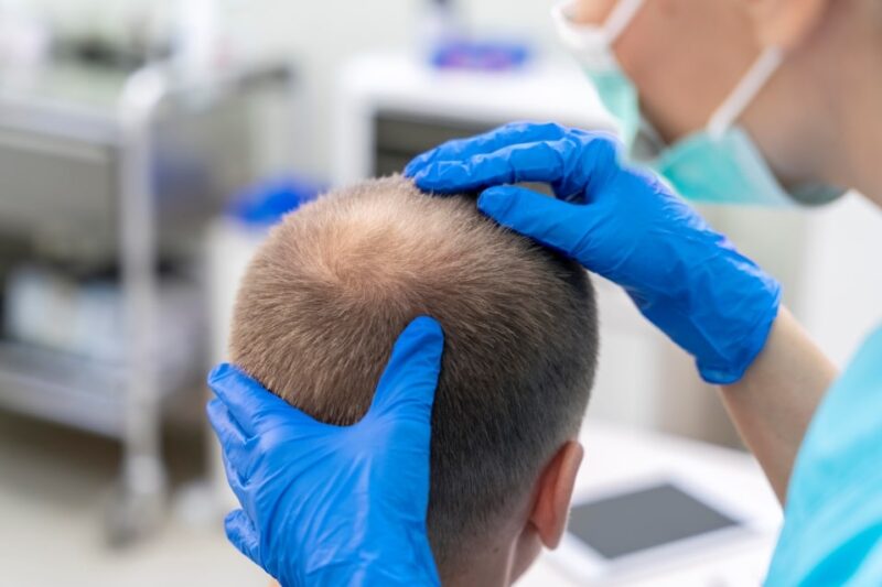 Transplante Capilar Pós-Operatório