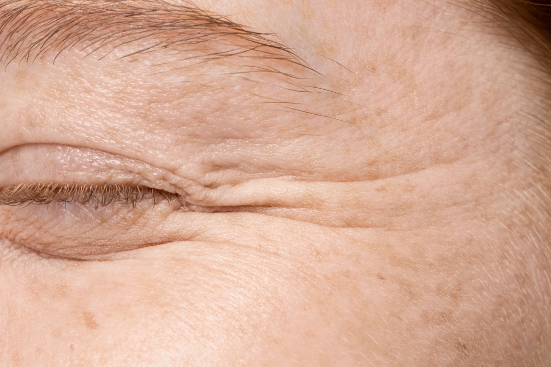 Tratamento de Linhas Finas com Botox: Como Rejuvenescer Mantendo a Naturalidade