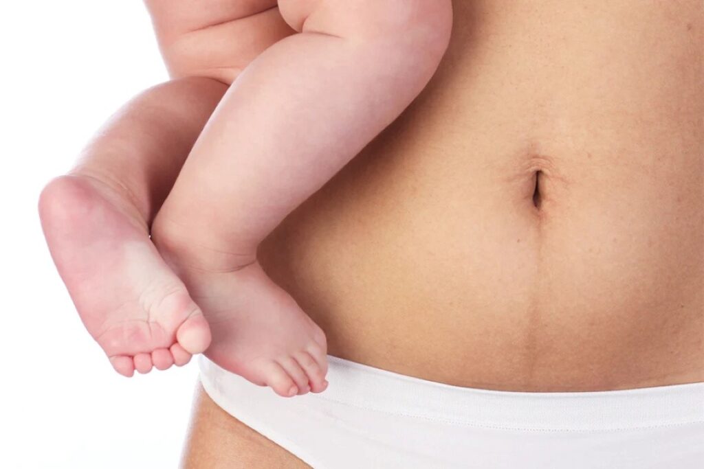 Flacidez-Abdominal-Pós-Gestação