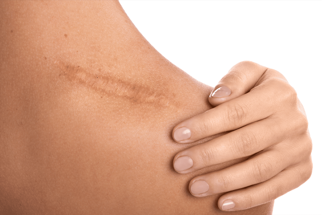 Camuflagem de Cicatriz com Micropigmentação: autoestima, naturalidade e resultado real