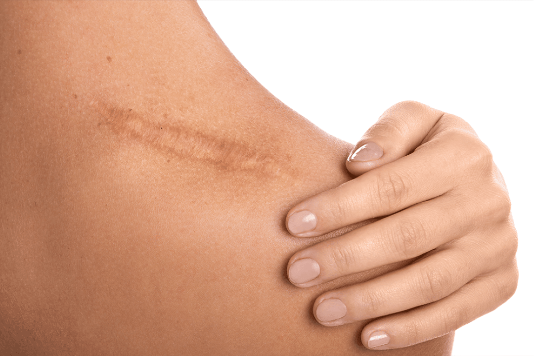 Camuflagem de Cicatriz com Micropigmentação: autoestima, naturalidade e resultado real