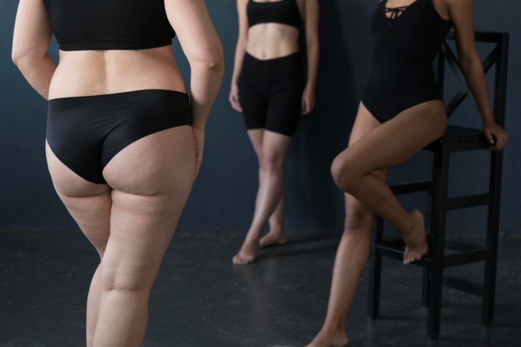 Lipedema: o que é e como tratamos na Clínica Dra. Andréa Severa