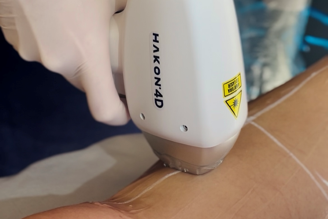 Depilação a Laser em 4D com Hakon: Tecnologia, Conforto e Resultados