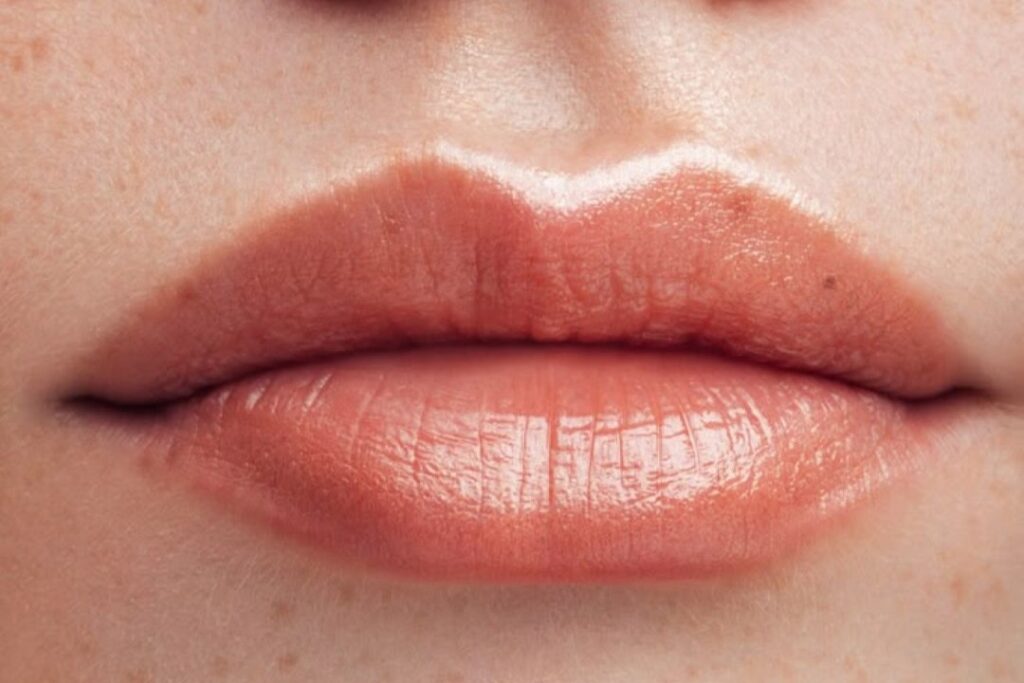Preenchimento Labial com Ácido Hialurônico: Realce Natural da Sua Beleza